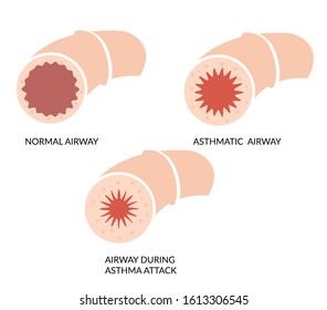 Asthma Blocked Airway - Icon  As EPS 10 File