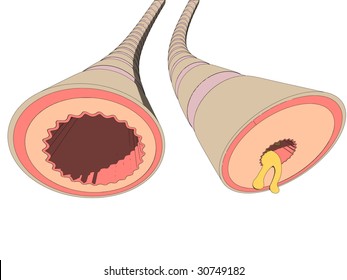 asma bronchiales