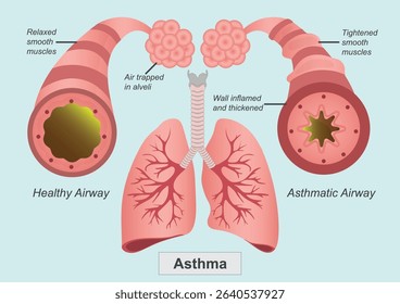 Asthma is a chronic condition that inflames and narrows the airways in the lungs.Medical healthcare, vector illustration. 