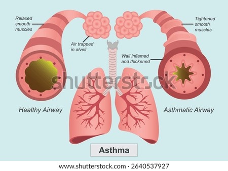 Asthma is a chronic condition that inflames and narrows the airways in the lungs.Medical healthcare, vector illustration. 