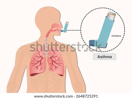 Asthma is a chronic lung disease affecting. It is caused by inflammation and muscle tightening around the airways,which airways narrow and swell, Medical healthcare vector illustration.