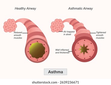 Asthma is a chronic respiratory condition where the airways in the lungs narrow, swell making it difficult to breathe. Medical healthcare vector illustration.Medical healthcare vector illustration.