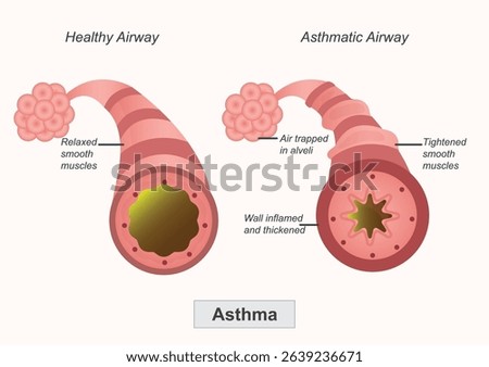 Asthma is a chronic respiratory condition where the airways in the lungs narrow, swell making it difficult to breathe. Medical healthcare vector illustration.Medical healthcare vector illustration.