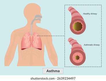 Asthma is a condition in which airways narrow and swell and may produce extra mucus.It is caused by inflammation and muscle tightening around the airways.Medical healthcare. vector illustration.