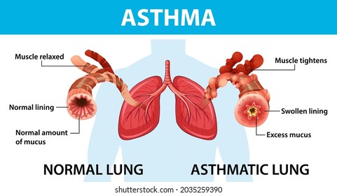 9,963 Asthmatic lung Images, Stock Photos & Vectors | Shutterstock