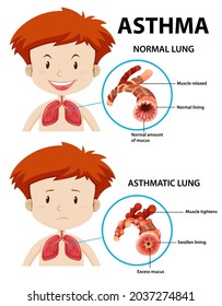 967 Asthma Diagram Images, Stock Photos & Vectors | Shutterstock