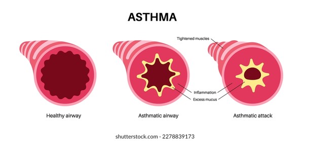 Asthma disease concept. Shortness of breath, chest tightness, causes of cough. Narrow and swell airways, extra mucus in lungs. Allergic condition, problem with respiratory system vector illustration