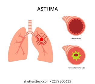 Konzept der Asthma-Krankheit. Atemnot, Engegefühl in der Brust, Ursachen für Husten. Schmale und glatte Atemwege, Extra Schleim in der Lunge. Allergische Erkrankung, Problem mit dem Atemsystem, Vektorgrafik