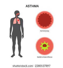 Asthma disease concept. Shortness of breath, chest tightness, causes of cough. Narrow and swell airways, extra mucus in lungs. Allergic condition, problem with respiratory system vector illustration