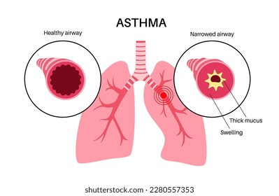 Konzept der Asthma-Krankheit. Atemnot, Engegefühl in der Brust, Ursachen für Husten. Schmale und glatte Atemwege, Extra Schleim in der Lunge. Allergische Erkrankung, Problem mit dem Atemsystem, Vektorgrafik