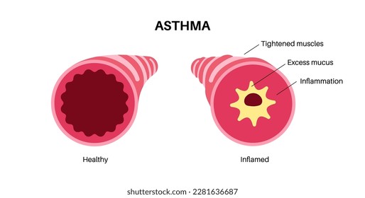 Asthma disease concept. Shortness of breath, chest tightness, causes of cough. Narrow and swell airways, extra mucus in lungs. Allergic condition, problem with respiratory system vector illustration