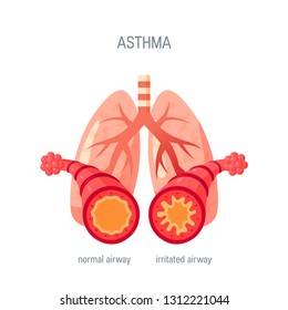 Asthma disease concept. Vector illustration in flat style for medical atlases, articles, infographics etc.