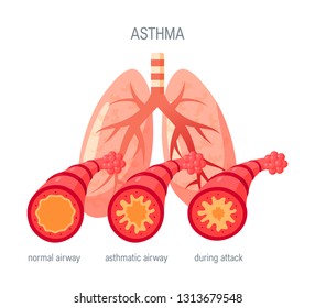 Asthma disease concept. Vector illustration in flat style for medical atlases, articles, infographics etc.