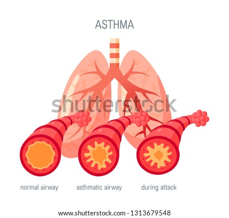 Asthma disease concept. Vector illustration in flat style for medical atlases, articles, infographics etc.