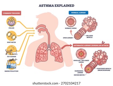 O diagrama explicado sobre a asma mostra pulmões, brônquios e gatilhos, contraste normal versus vias respiratórias asmáticas mostrando inflamação, muco e músculos apertados causando problemas respiratórios. Diagrama de estrutura de tópicos