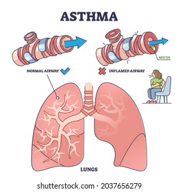 Asthma health condition compared normal and inflamed airway outline diagram. Labeled educational differences with healthy and inflamed airway in comparison scheme vector illustration. Coughing symptom