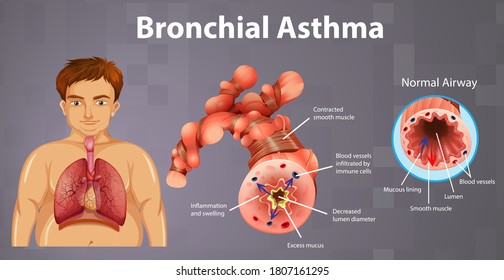 Asthma Inflamed Bronchial Tube Illustration Stock Vector (Royalty Free ...