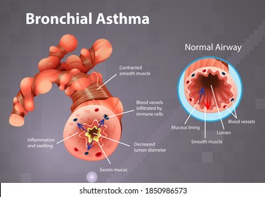 Asthma Inflamed Bronchial Tube Illustration