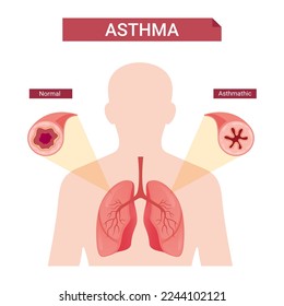 Asthma infographic, concept human asthma vector