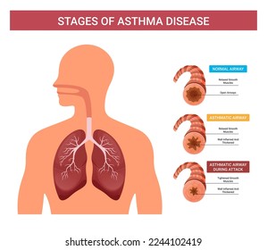 Asthma infographics, vector stages of human asthma