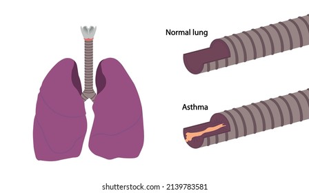 Ilustración de Asthma Lung. bronquios sanos e inflamados con mucosa.  