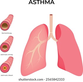 Asthma Normal Airway Asthmatic Airway Asthmatic Attack Design Vector Illustration	