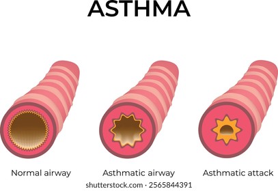 Asthma Normal Airway Asthmatic Airway Asthmatic Attack Design Vector Illustration