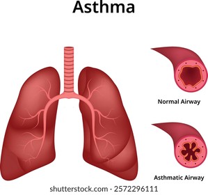 Asthma Normal Airway Asthmatic Airway Design Vector Illustration