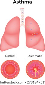Asma Normal vs Pulmões Asmáticos e Comparação de Bronquíolos Ilustração de Vetor