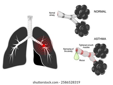 Asthma. Respiratory disease. Black lungs with red mark, and bronchi on white background. Close-up of normal airway, Bronchoconstriction, inflammation, Mucus production 