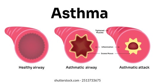 Asthma Science Design Vektorgrafik Diagramm