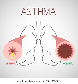 Asthma vector icon illustration