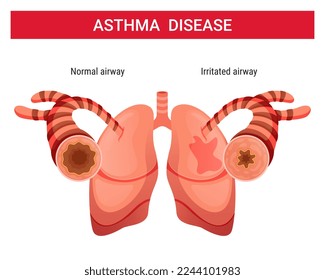 Ilustración vector de asma ,infografía de asma
