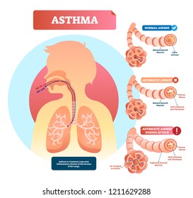 Asthma vector illustration. Lungs and bronchi disease with breathing problems diagram. Asthmatic and normal airway cross section with labeled structure and symptoms.