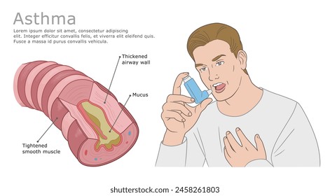 Asthmatic airway diagram and man with inhaler. Asthma medical vector  illustration.