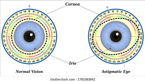 Astigmatism is a common vision condition that causes blurred vision.