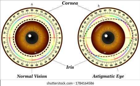 Astigmatism is a common vision condition that causes blurred vision.