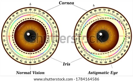 Astigmatism is a common vision condition that causes blurred vision.