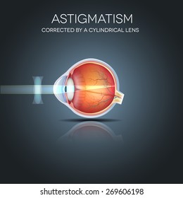 Astigmatism corrected by a cylindrical lens. Eyesight problem, blurred vision. Anatomy of the eye, cross section. 