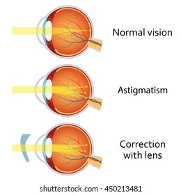 Myopia Vision Disorders Illustration Eyes Defect Stock Vector (Royalty ...