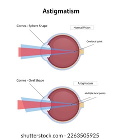 Astigmatism disease, normal vision and astigmatism illustration design