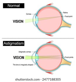 Astigmatism. Eye anatomy. Lens, Cornea and Focal points on Retina in normal and astigmatic eye. Cross section of a Human eyeball. Diagram for education and medical use. Vector illustration