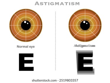 Astigmatismo ocular, visão turva. Ver rotação, vertical e horizontal. Círculo de assimetria da córnea. Íris castanha. Ponto focal. Carta E. Ilustração vetorial