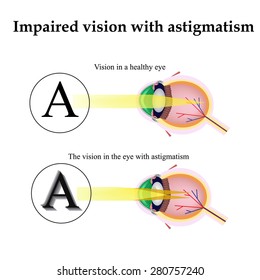 Astigmatism Stock Vectors, Images & Vector Art | Shutterstock