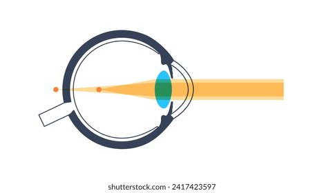 Astigmatismus Augenkrankheit. Refraktives medizinisches Poster. Verschwommenes Sehen in jeder Entfernung. Sehverzerrung durch ungleichmäßige Hornhaut- oder Linsenkrümmung. Human eye flache Vektorgrafik