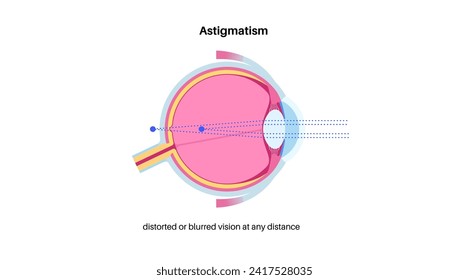 Astigmatism eye disease. Refractive error medical poster. Blurred vision problem at any distance. Visual distortion caused by uneven corneal or lens curvature. Human eye flat vector illustration