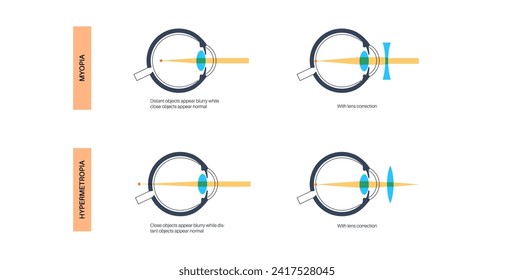 Astigmatismo ocular. Afiche médico de error refractivo. Problema de visión borrosa a cualquier distancia. Distorsión visual causada por una corneal o curvatura desigual de la lente. Ilustración de vector plano de ojos humanos