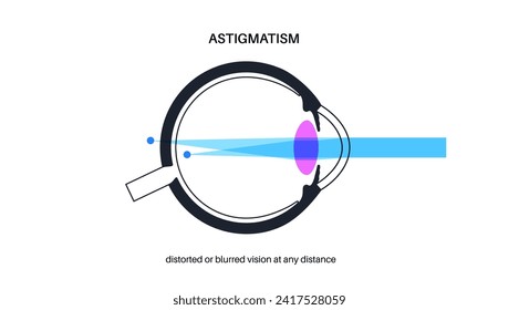 Astigmatism eye disease. Refractive error medical poster. Blurred vision problem at any distance. Visual distortion caused by uneven corneal or lens curvature. Human eye flat vector illustration