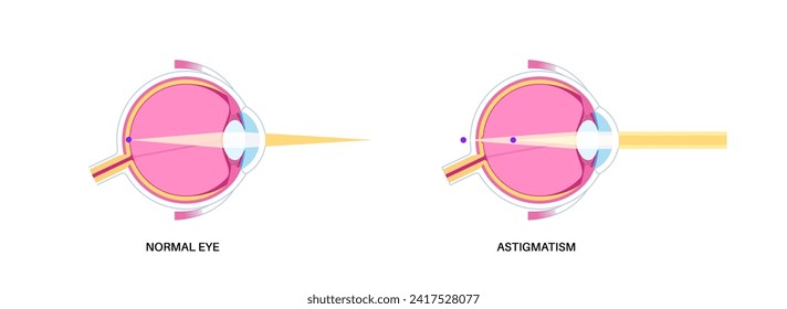 Astigmatism eye disease. Refractive error medical poster. Blurred vision problem at any distance. Visual distortion caused by uneven corneal or lens curvature. Human eye flat vector illustration