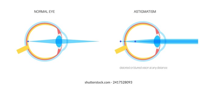 Astigmatism eye disease. Refractive error medical poster. Blurred vision problem at any distance. Visual distortion caused by uneven corneal or lens curvature. Human eye flat vector illustration